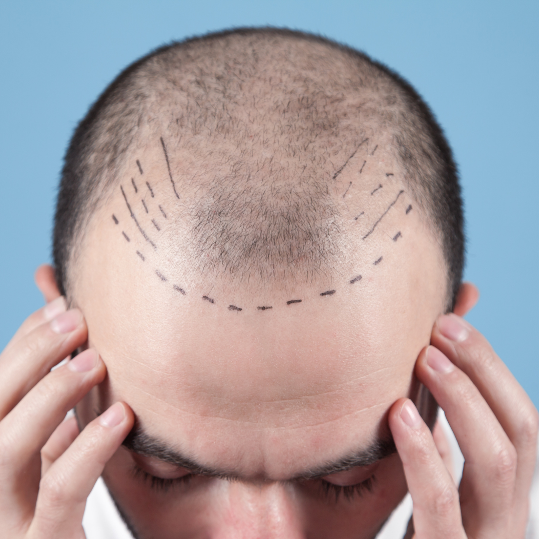 FUE Hair Transplant